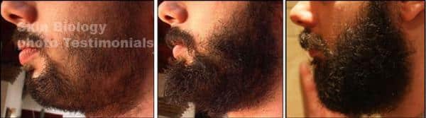 minoxidil para a barba antes e depois 1