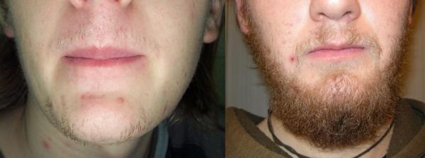 qual o uso do Minoxidil para barba