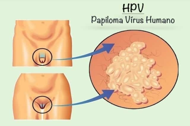Verrugas genitais HPV