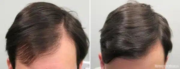 minoxidil calvície antes e depois 2