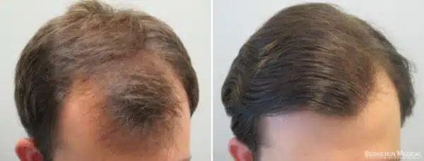 minoxidil calvície antes e depois 3