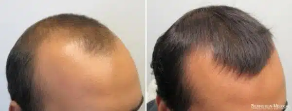 minoxidil calvície antes e depois 4