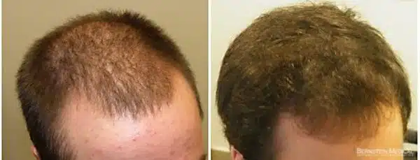 minoxidil calvície antes e depois 1