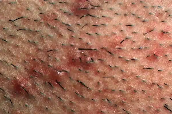 Foliculite, o verdadeiro mal dos homens barbudos