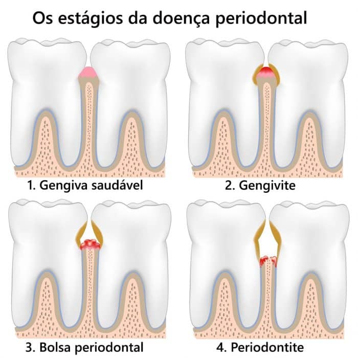 Estados da doença periodontal