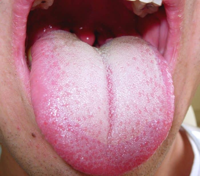Saburra lingual que causa mau hálito