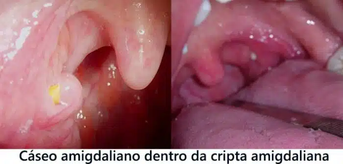 caseo amigdaliano dentro da cripta amigdaliana