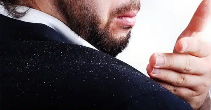 caspa é mais comum no inverno do que você pensa