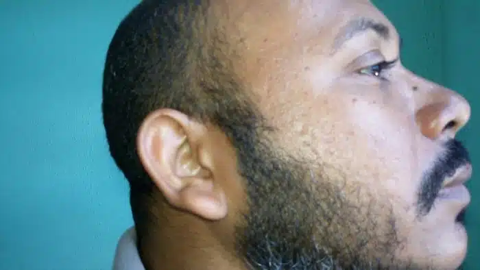 O Finasterida tem sido utilizado também nos cuidados com a barba