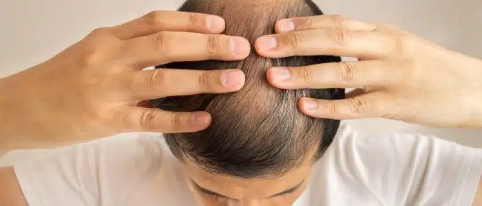 Mesmo com bons efeitos, o Finasterida também é arriscado