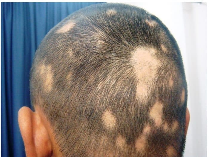 A Alopecia areata ocorre por níveis extremos de estresse