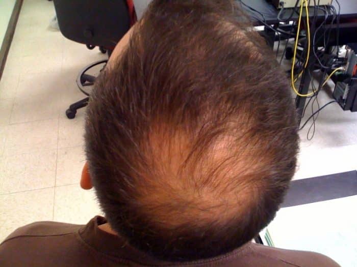 O que é Alopecia? Descubra com a gente