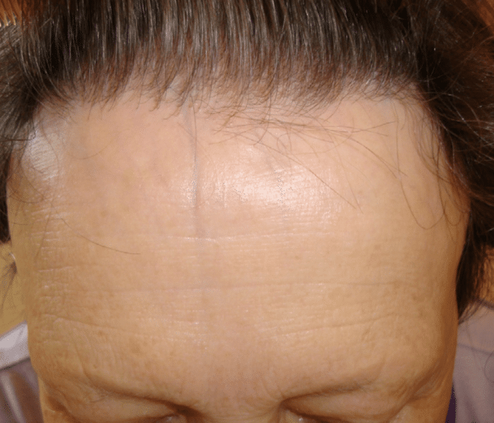A Alopecia Frontal Fibrosante ocorre na maior parte das vezes em mulheres