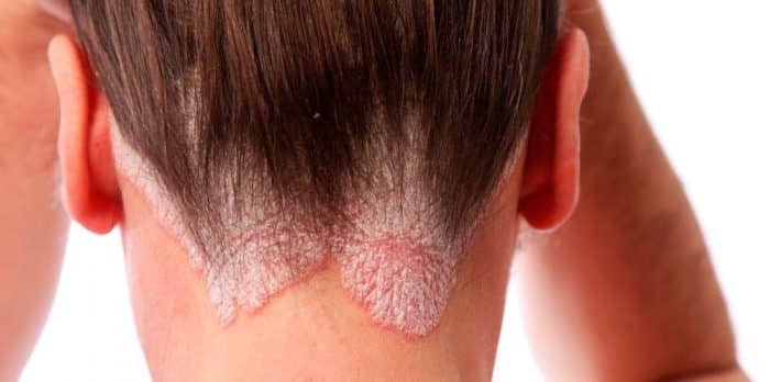 Alopecia Seborreica ocorre pelo excesso de caspa, dentre outras coisas