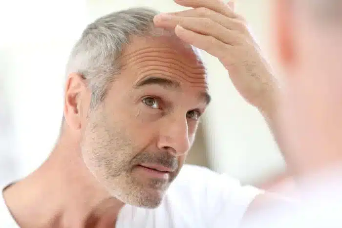A genética influencia muito na Queda de Cabelo