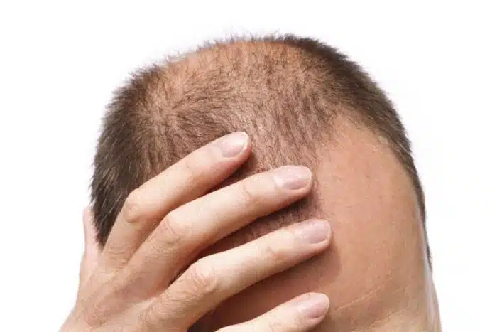 A Queda de Cabelo é causada facilmente pelo estresse