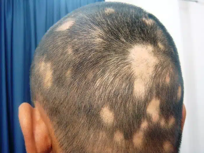 Diversas doenças podem ter como consequência a Queda de Cabelo