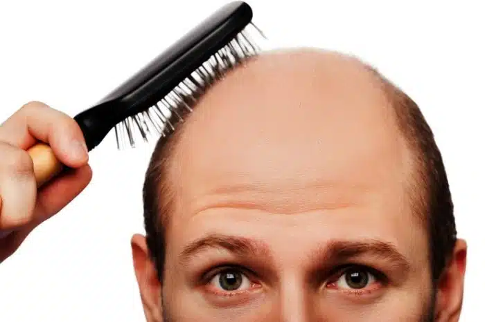 A Queda de Cabelo pode ser evitada com atitudes simples. Siga-as, e seus cabelos viverão muito mais