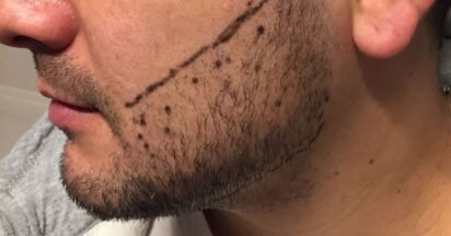 Transplante de barba: Revolução na estética masculina!