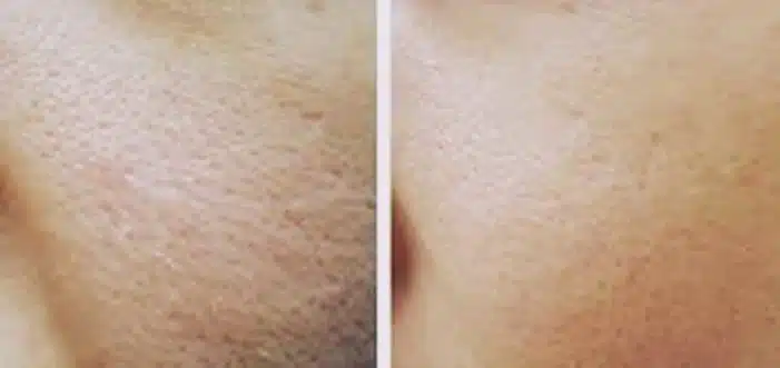 A Pedra hume pode ser usada muito bem na barba, veja como!