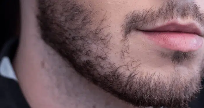 Dê um jeito na Foliculite na Barba