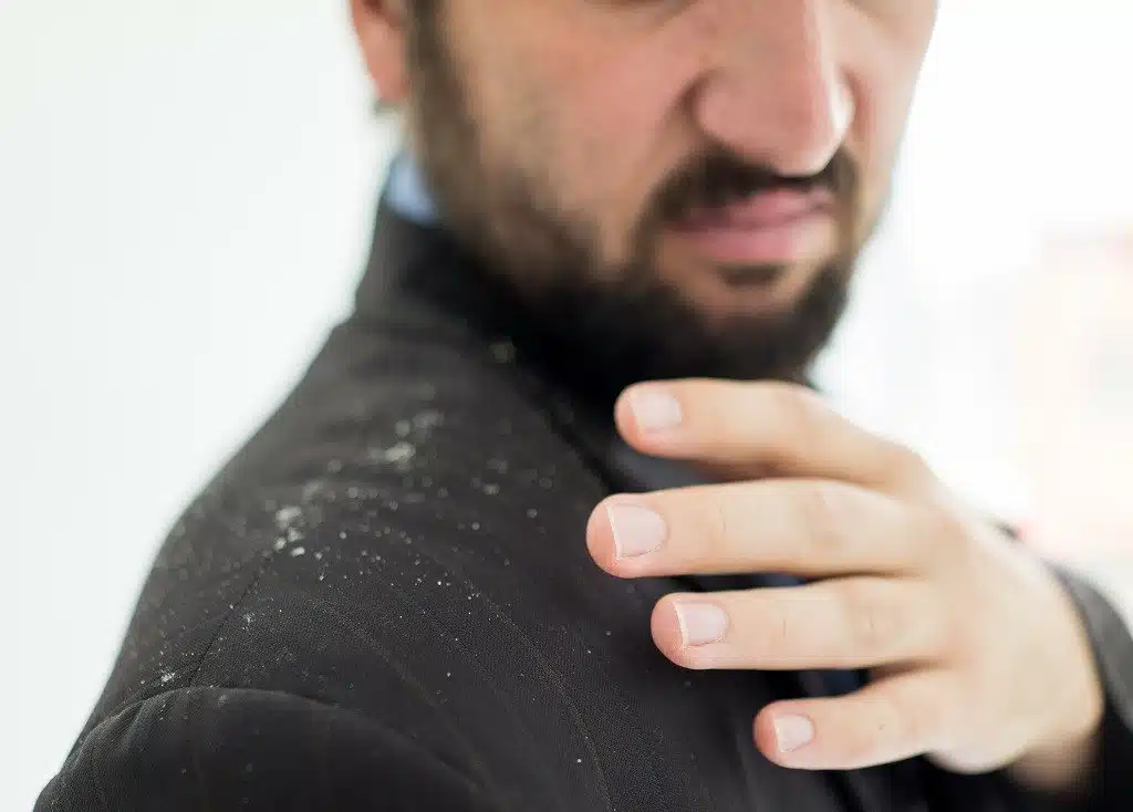 caspa na barba caindo no paletó