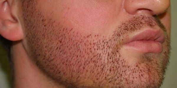 barba implantada