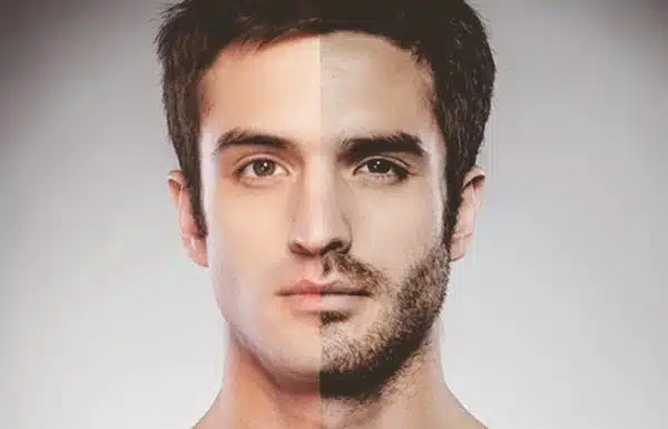 barba transplante