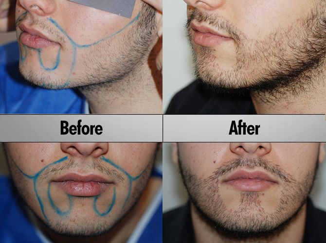 resultado transresultado transplante de barbaplante de barba