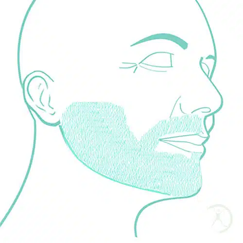 Transplante de barba