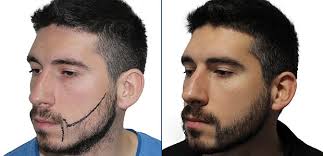 transplante de barba resultado