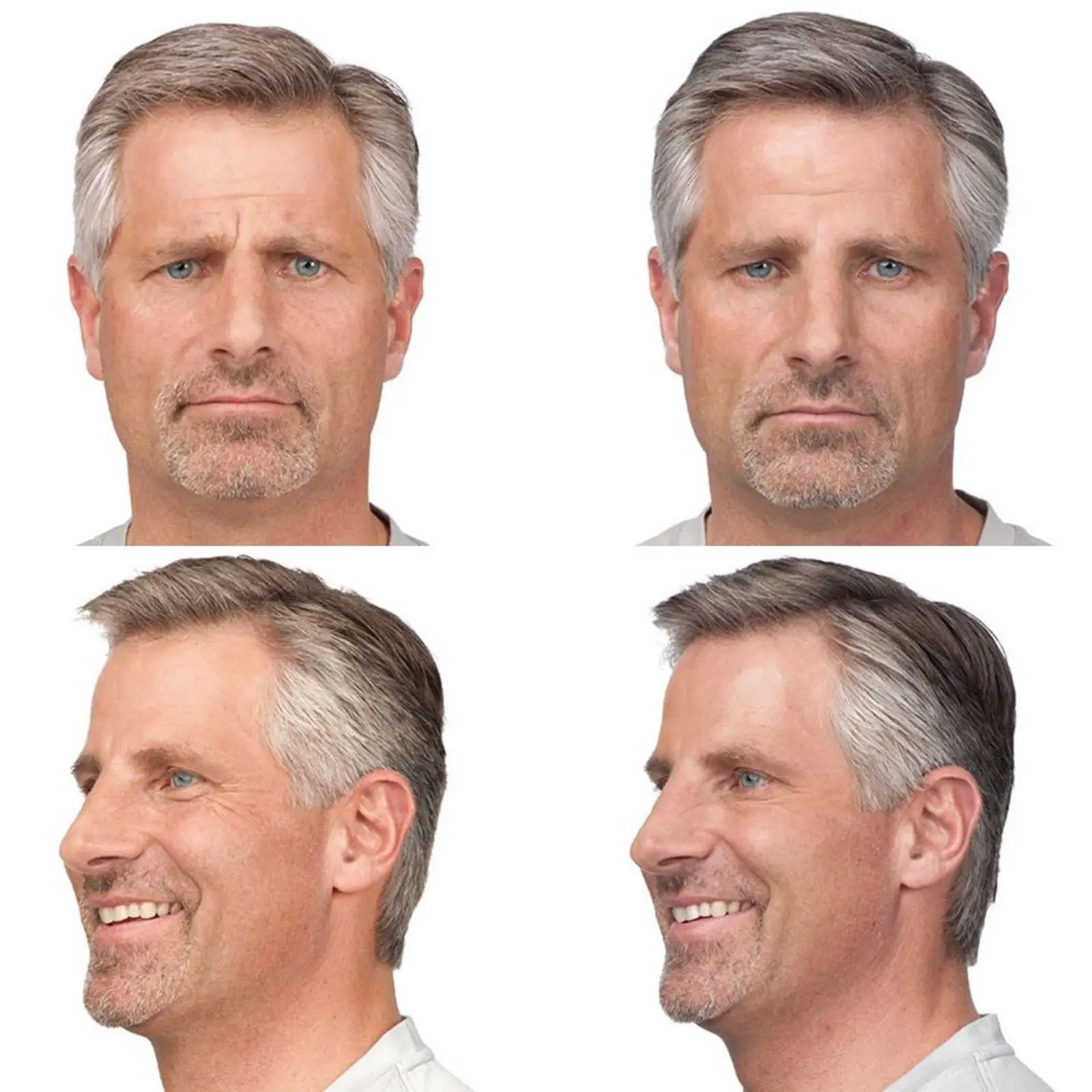 TOXINA BOTULÍNICA Botox